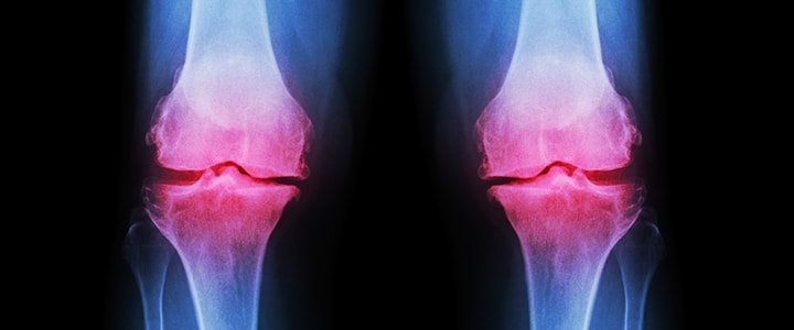 Arthritis