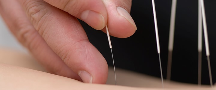 Acupuncture